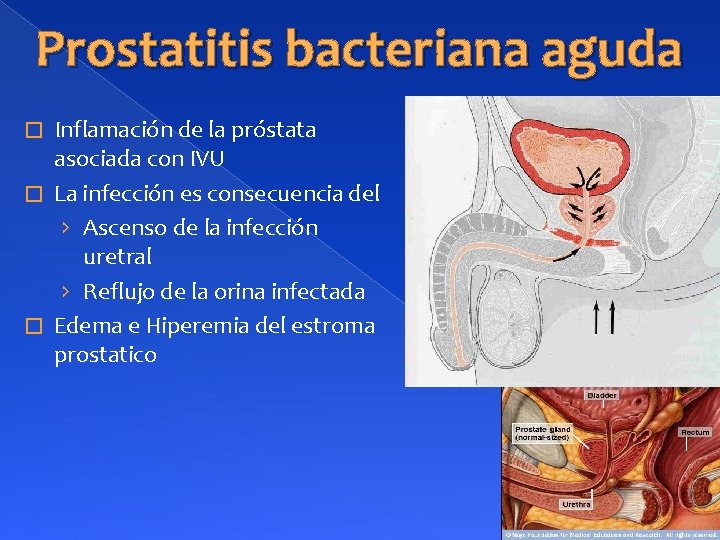 Prostatitis bacteriana aguda Inflamación de la próstata asociada con IVU � La infección es