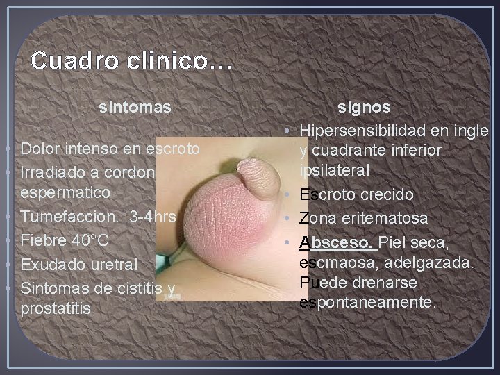 Cuadro clinico… sintomas • Dolor intenso en escroto • Irradiado a cordon espermatico •