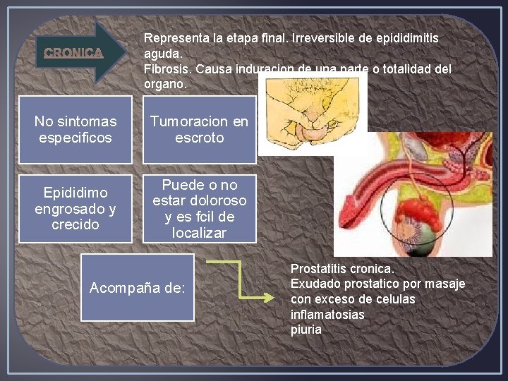 CRONICA Representa la etapa final. Irreversible de epididimitis aguda. Fibrosis. Causa induracion de una