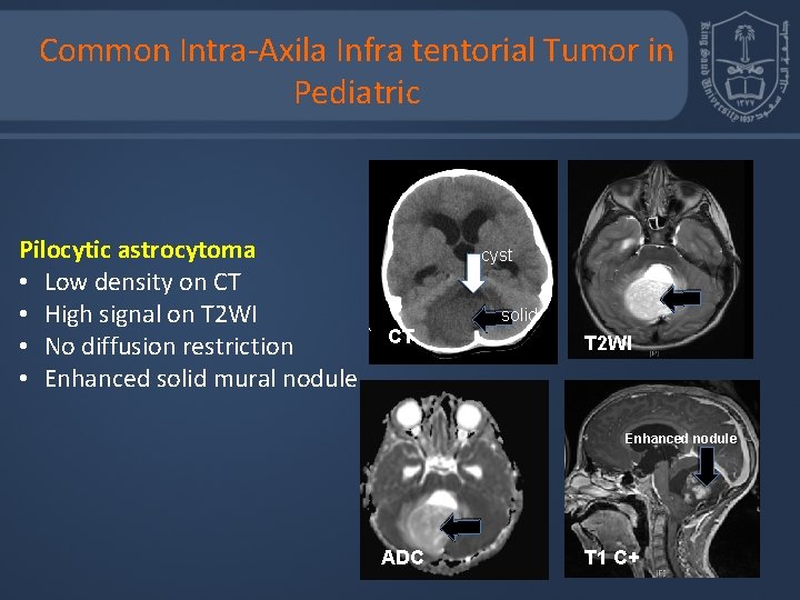 Common Intra-Axila Infra tentorial Tumor in Pediatric Pilocytic astrocytoma • Low density on CT