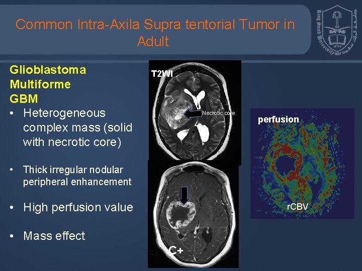 Common Intra-Axila Supra tentorial Tumor in Adult Glioblastoma Multiforme GBM • Heterogeneous complex mass