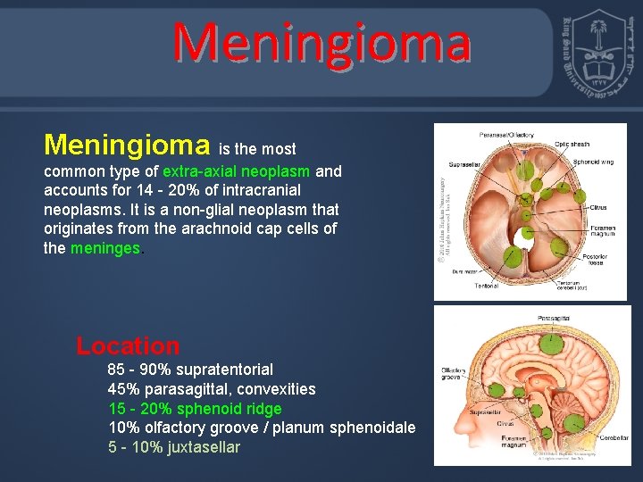 Meningioma is the most common type of extra-axial neoplasm and accounts for 14 -