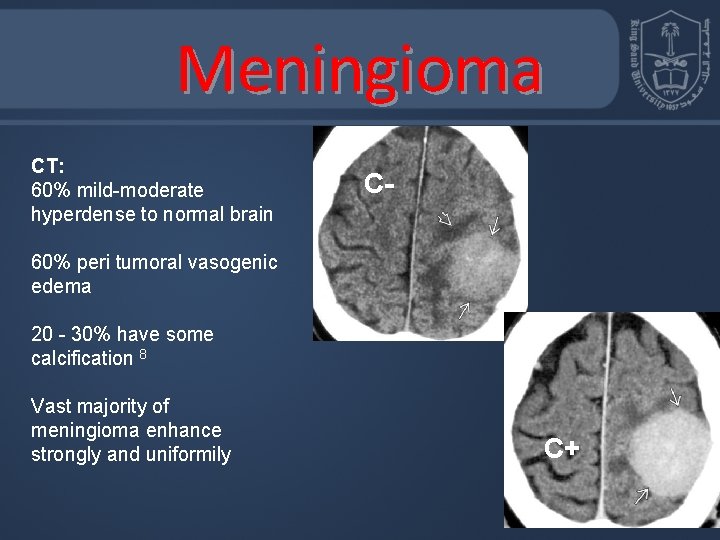 Meningioma CT: 60% mild-moderate hyperdense to normal brain C- 60% peri tumoral vasogenic edema