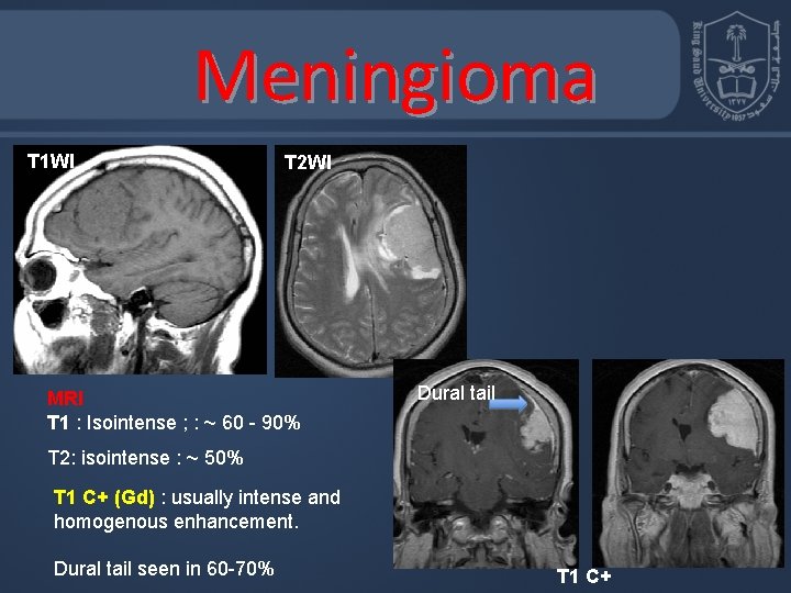 Meningioma T 1 WI T 2 WI MRI T 1 : Isointense ; :