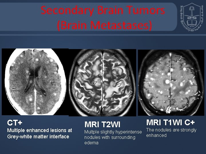 Secondary Brain Tumors (Brain Metastases) CT+ Multiple enhanced lesions at Grey-white matter interface MRI