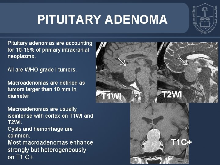 PITUITARY ADENOMA Pituitary adenomas are accounting for 10 -15% of primary intracranial neoplasms. All