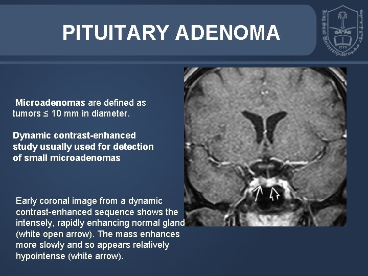 PITUITARY ADENOMA Microadenomas are defined as tumors ≤ 10 mm in diameter. Dynamic contrast-enhanced