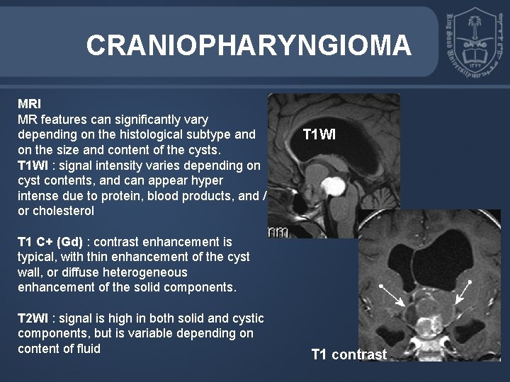 CRANIOPHARYNGIOMA MRI MR features can significantly vary depending on the histological subtype and on