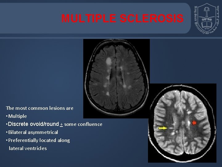 MULTIPLE SCLEROSIS The most common lesions are • Multiple • Discrete ovoid/round + some