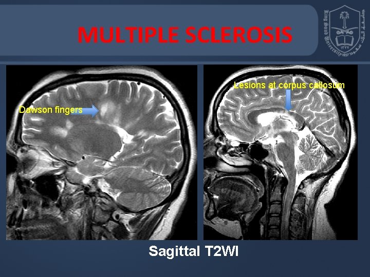 MULTIPLE SCLEROSIS Lesions at corpus callosum Dawson fingers Sagittal T 2 WI 