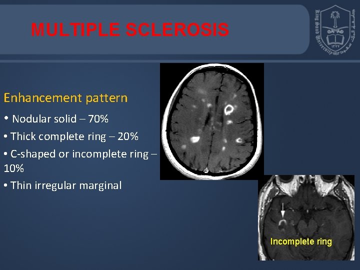 MULTIPLE SCLEROSIS Enhancement pattern • Nodular solid – 70% • Thick complete ring –