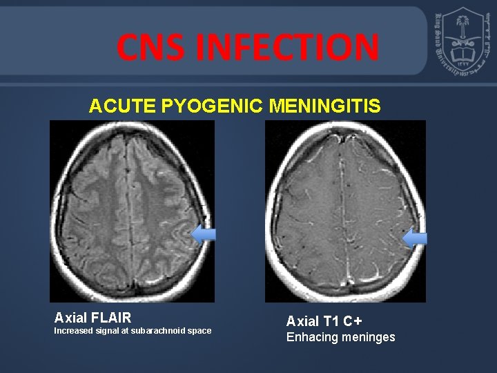 CNS INFECTION ACUTE PYOGENIC MENINGITIS Axial FLAIR Increased signal at subarachnoid space Axial T