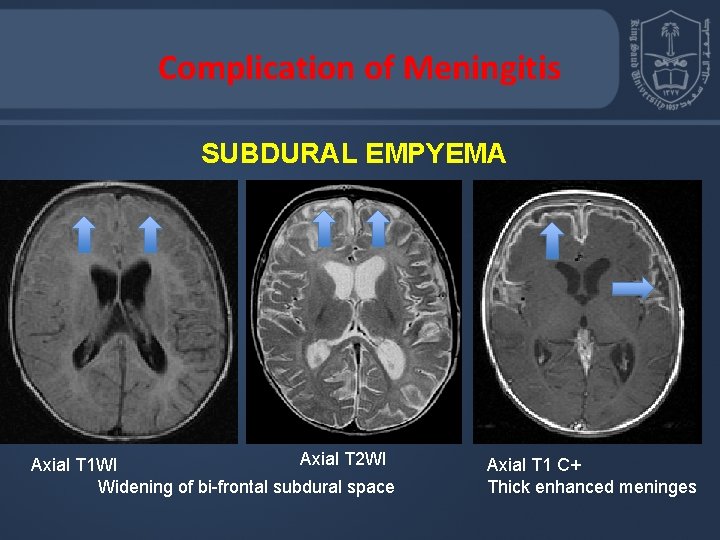 Complication of Meningitis SUBDURAL EMPYEMA Axial T 2 WI Axial T 1 WI Widening