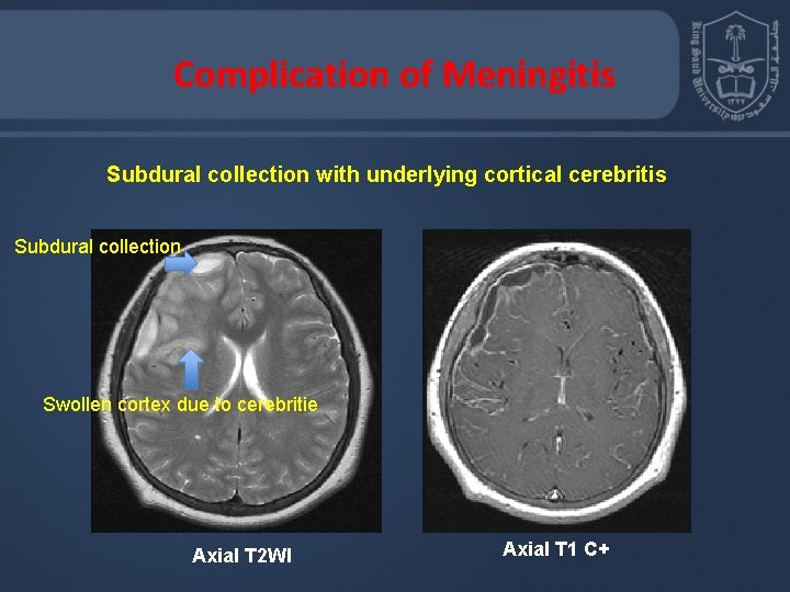 Complication of Meningitis Subdural collection with underlying cortical cerebritis Subdural collection Swollen cortex due