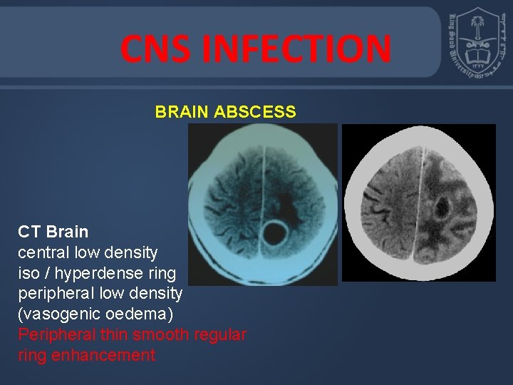 CNS INFECTION BRAIN ABSCESS CT Brain central low density iso / hyperdense ring peripheral