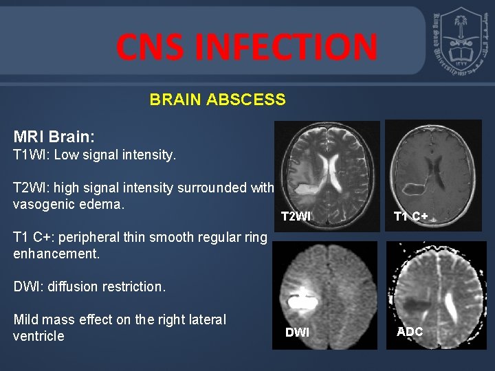 CNS INFECTION BRAIN ABSCESS MRI Brain: T 1 WI: Low signal intensity. T 2