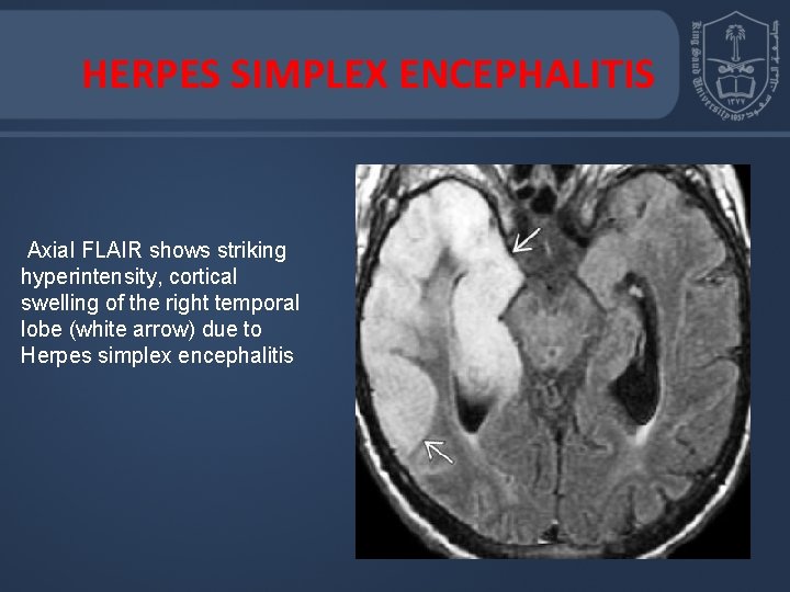 HERPES SIMPLEX ENCEPHALITIS Axial FLAIR shows striking hyperintensity, cortical swelling of the right temporal
