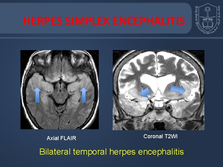 HERPES SIMPLEX ENCEPHALITIS Axial FLAIR Coronal T 2 WI Bilateral temporal herpes encephalitis 