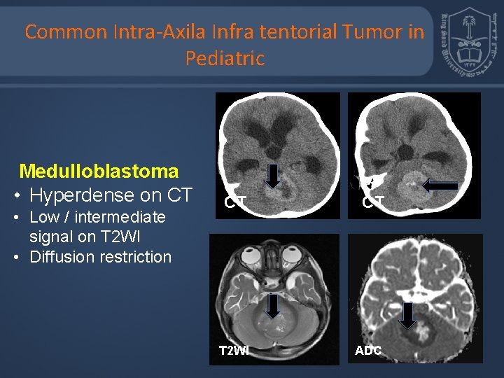 Common Intra-Axila Infra tentorial Tumor in Pediatric Medulloblastoma • Hyperdense on CT • Low