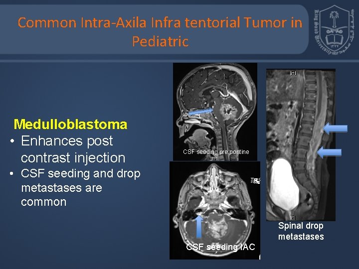 Common Intra-Axila Infra tentorial Tumor in Pediatric Medulloblastoma • Enhances post contrast injection CSF