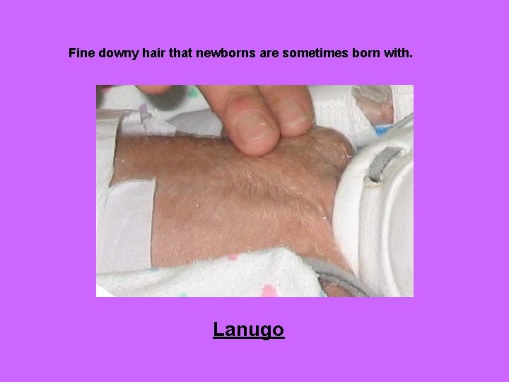 Fine downy hair that newborns are sometimes born with. Lanugo 