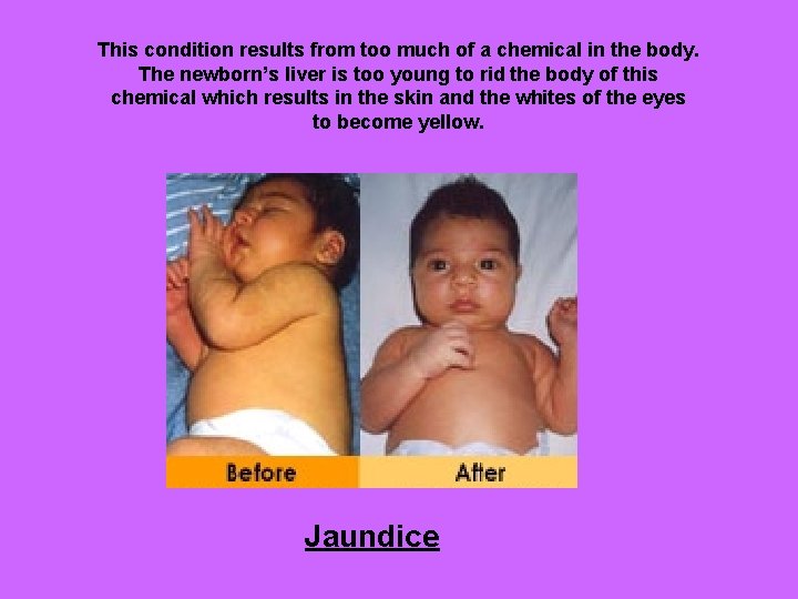 This condition results from too much of a chemical in the body. The newborn’s
