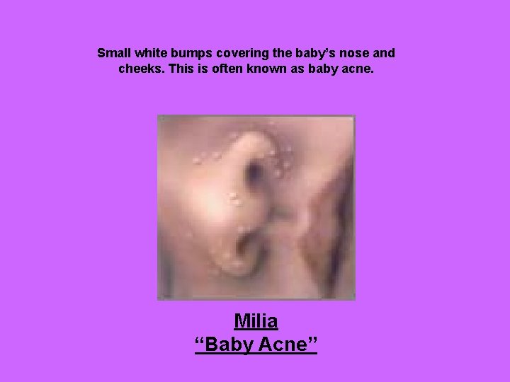Small white bumps covering the baby’s nose and cheeks. This is often known as