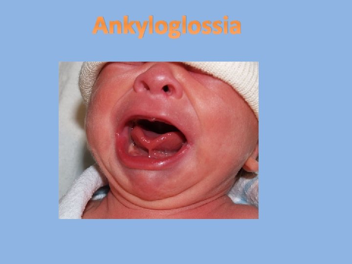 Ankyloglossia 