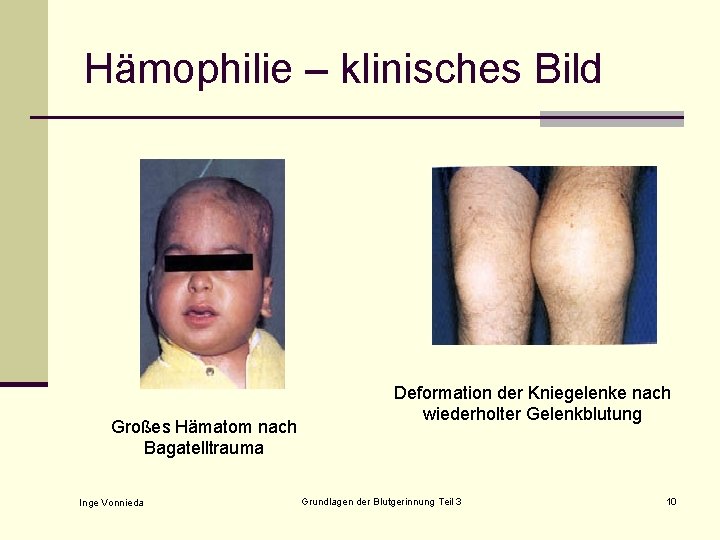 Hämophilie – klinisches Bild Großes Hämatom nach Bagatelltrauma Inge Vonnieda Deformation der Kniegelenke nach