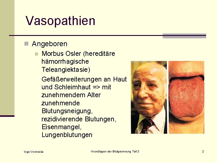 Vasopathien n Angeboren n Morbus Osler (hereditäre hämorrhagische Teleangiektasie) Gefäßerweiterungen an Haut und Schleimhaut