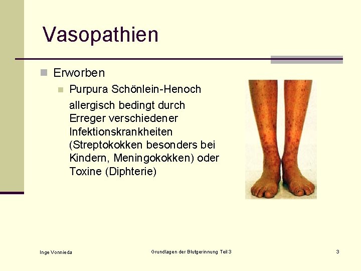 Vasopathien n Erworben n Purpura Schönlein-Henoch allergisch bedingt durch Erreger verschiedener Infektionskrankheiten (Streptokokken besonders