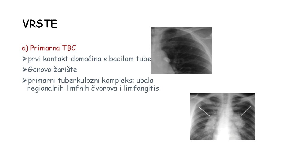 VRSTE a) Primarna TBC Øprvi kontakt domaćina s bacilom tuberkuloze ØGonovo žarište Øprimarni tuberkulozni