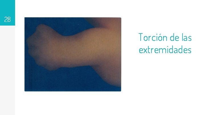 28 Torción de las extremidades 