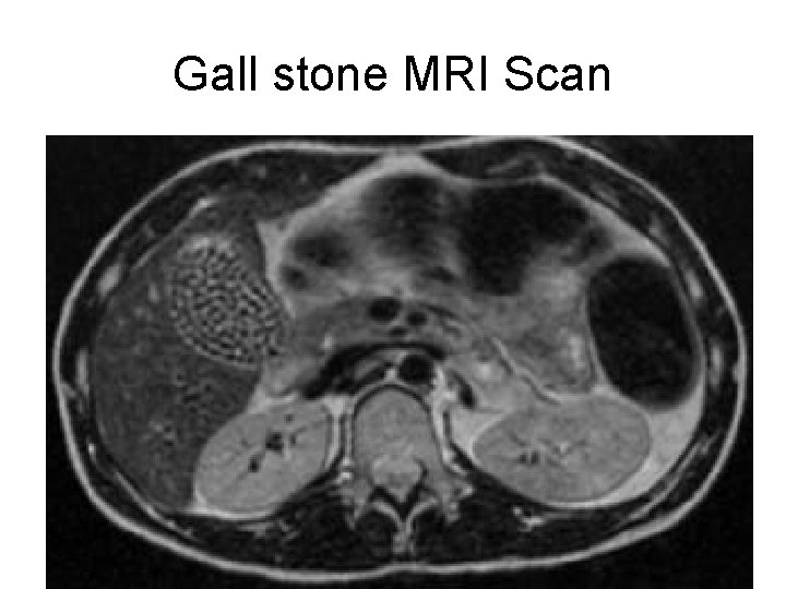 Gall stone MRI Scan 