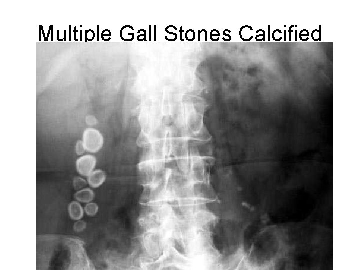 Multiple Gall Stones Calcified 