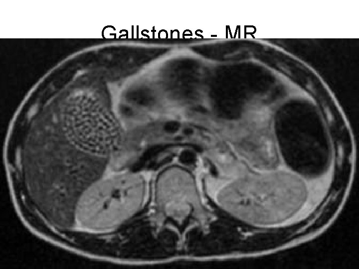 Gallstones - MR 