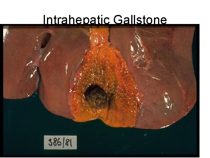 Intrahepatic Gallstone 