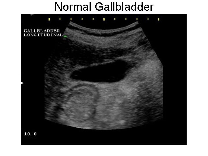 Normal Gallbladder 