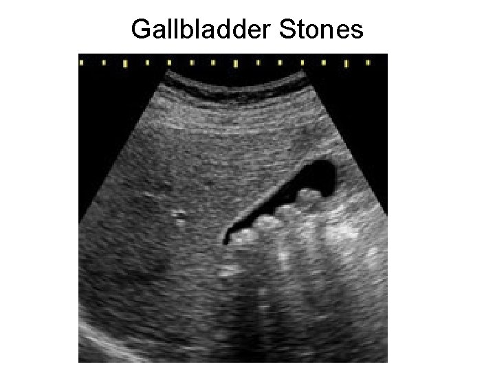 Gallbladder Stones 