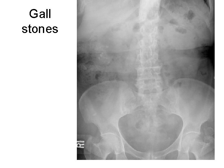 Gall stones 