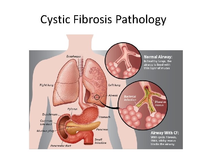 Cystic Fibrosis Pathology 