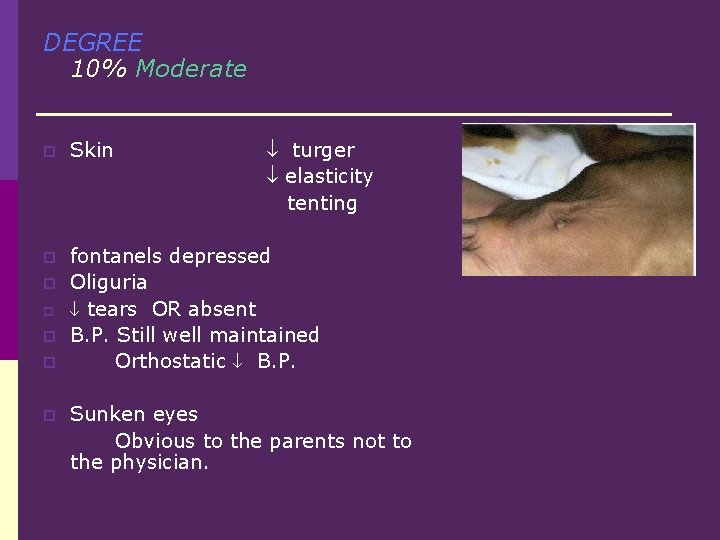 DEGREE 10% Moderate p Skin p fontanels depressed Oliguria tears OR absent B. P.