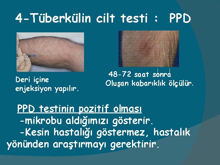 4 -Tüberkülin cilt testi : PPD Deri içine enjeksiyon yapılır. 48 -72 saat sonra