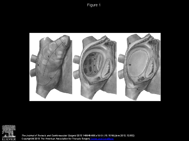 Figure 1 The Journal of Thoracic and Cardiovascular Surgery 2013 145648 -655. e 1