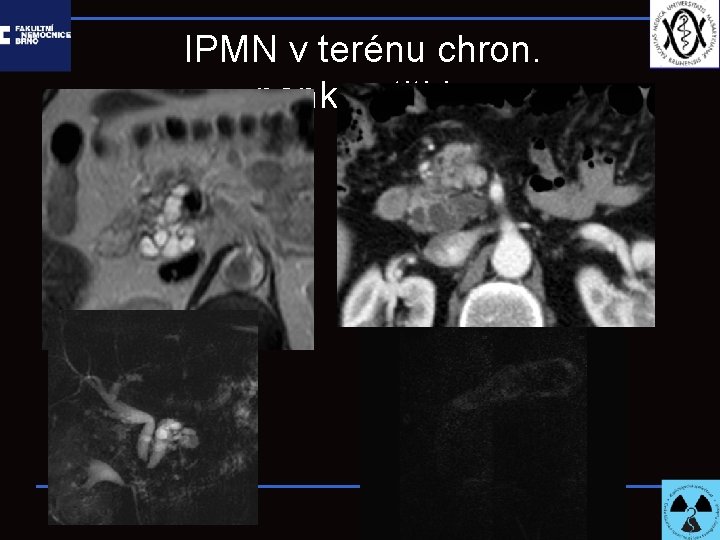 IPMN v terénu chron. pankreatitidy 