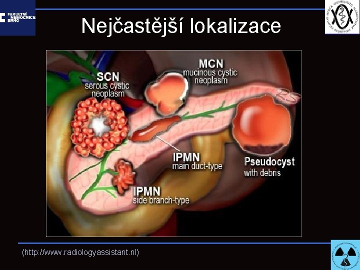 Nejčastější lokalizace (http: //www. radiologyassistant. nl) 