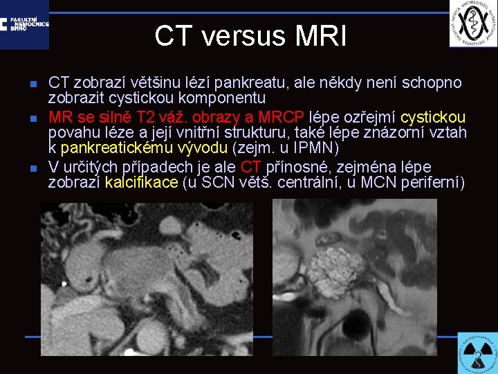 CT versus MRI n n n CT zobrazí většinu lézí pankreatu, ale někdy není