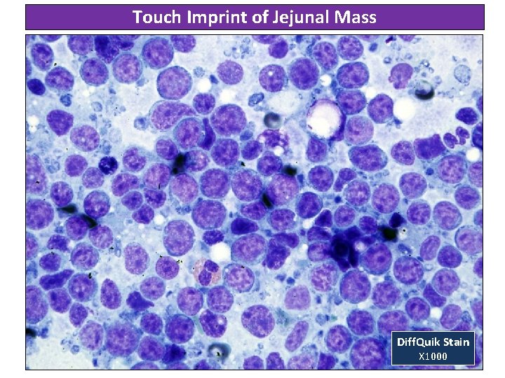 Touch Imprint of Jejunal Mass Diff. Quik Stain X 1000 