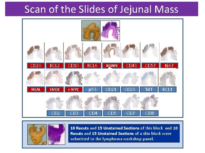 Scan of the Slides of Jejunal Mass CD 20 BCL 2 CD 10 BCL