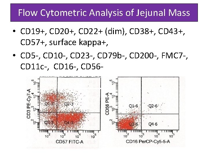 Flow Cytometric Analysis of Jejunal Mass • CD 19+, CD 20+, CD 22+ (dim),